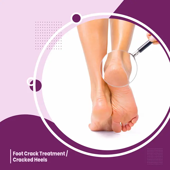 Foot Crack Treatment/ Cracked Heels