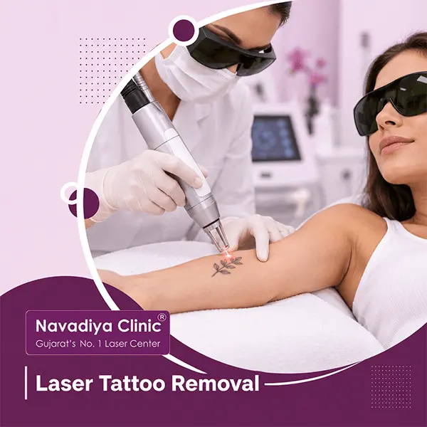 Laser Tattoo Removal in Surat
