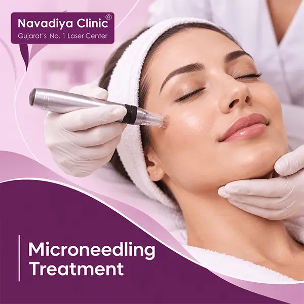 Microneedling Treatment in Surat